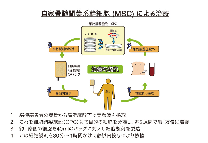 自家骨髄間葉系幹細胞 (MSC) による治療
